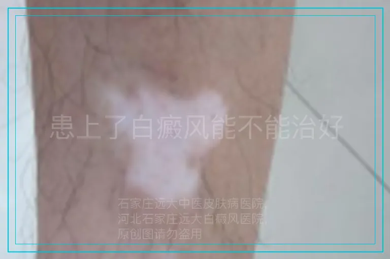 患上了白癜风能不能治好