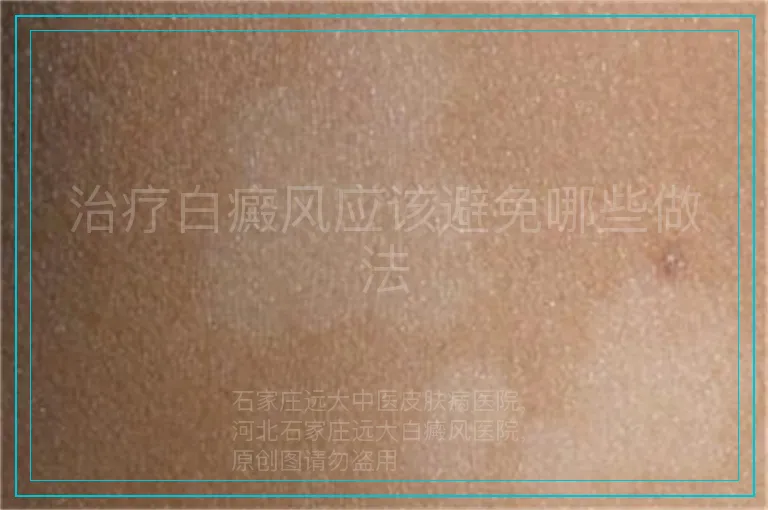 治疗白癜风应该避免哪些做法
