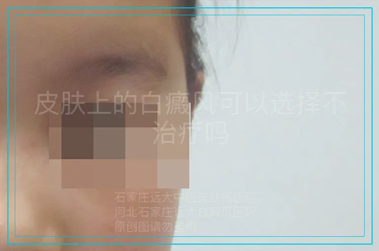 皮肤上的白癜风可以选择不治疗吗