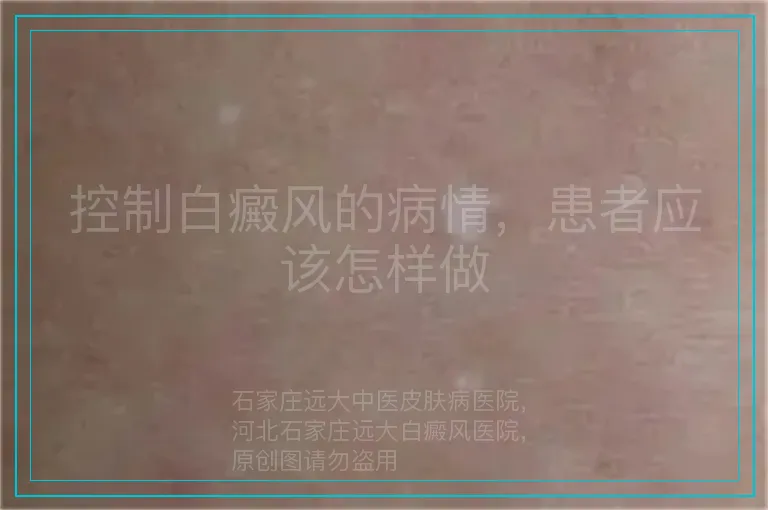 控制白癜风的病情,患者应该怎样做