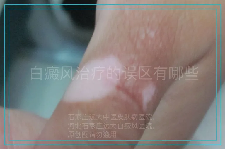白癜风治疗的误区有哪些