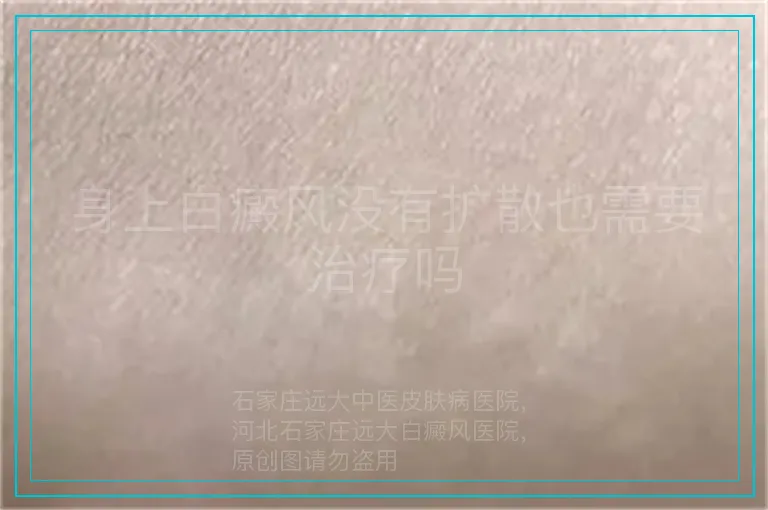 身上白癜风没有扩散也需要治疗吗