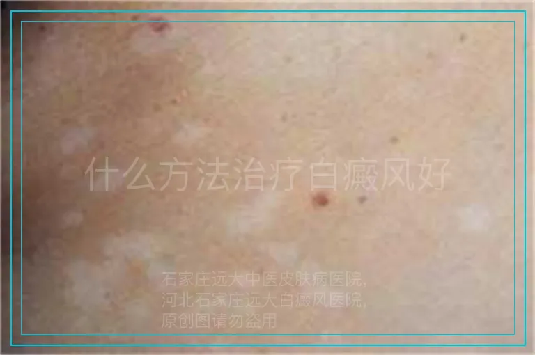 什么方法治疗白癜风好