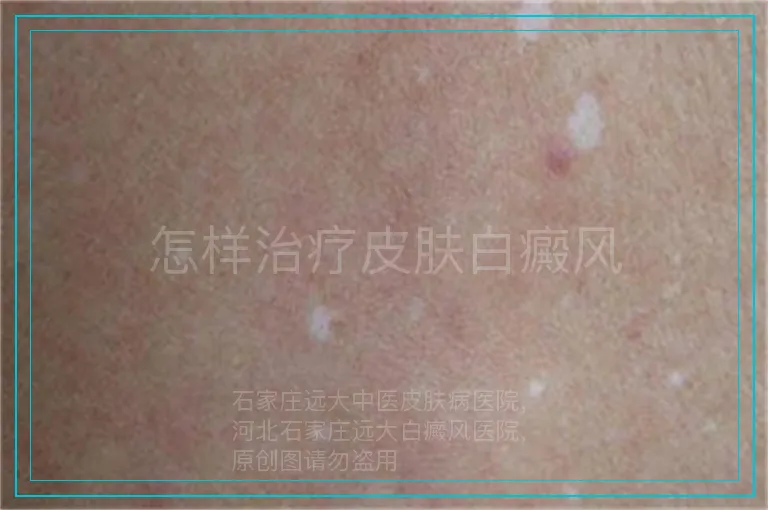 怎样治疗皮肤白癜风