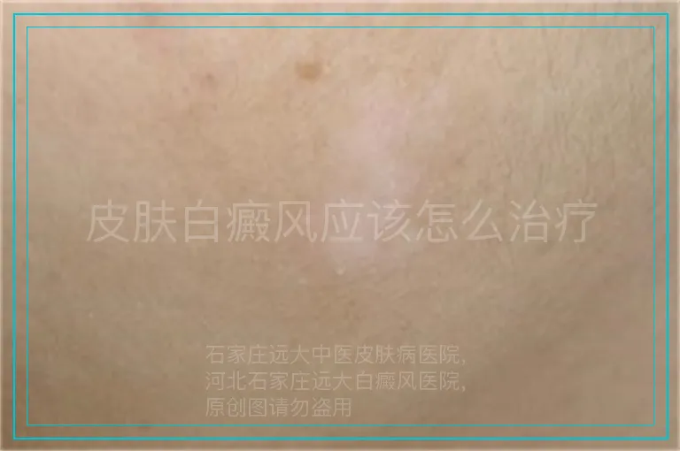 皮肤白癜风应该怎么治疗