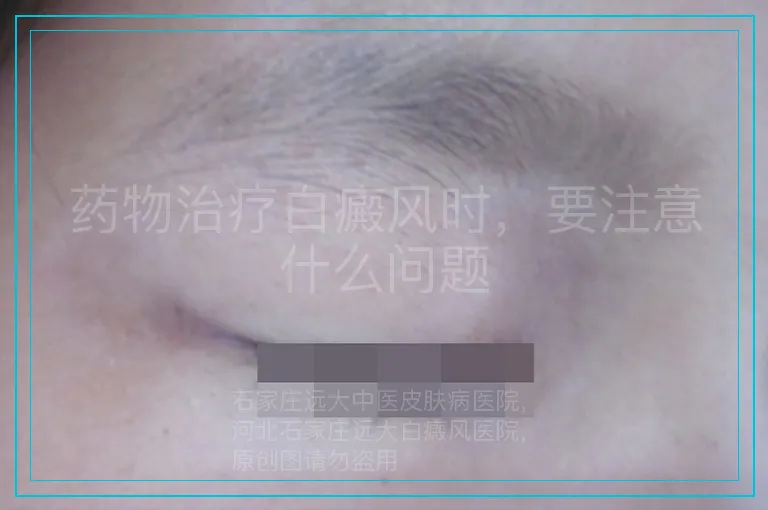 药物治疗白癜风时,要注意什么问题