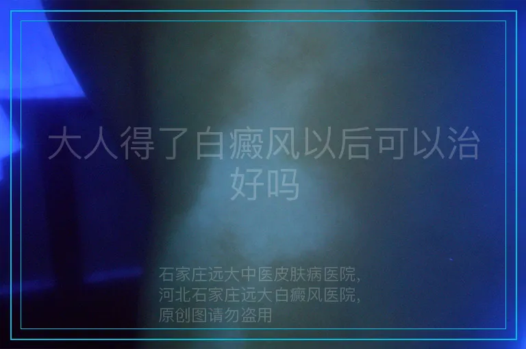 大人得了白癜风以后可以治好吗