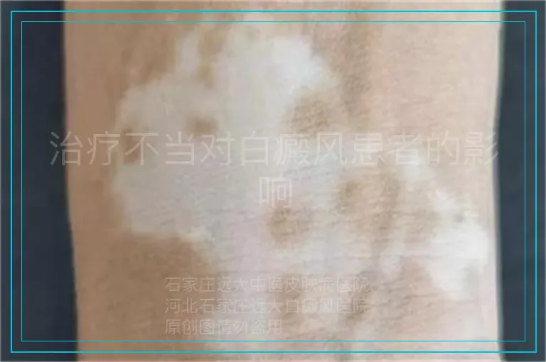 治疗不当对白癜风患者的影响
