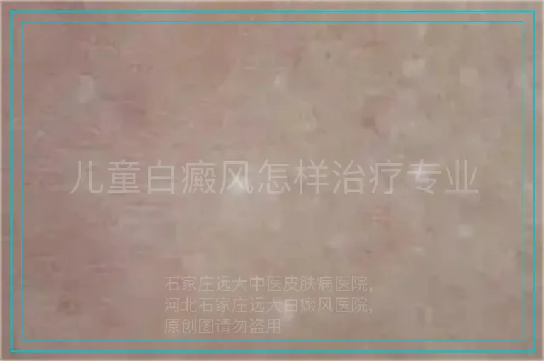 儿童白癜风怎样治疗专业