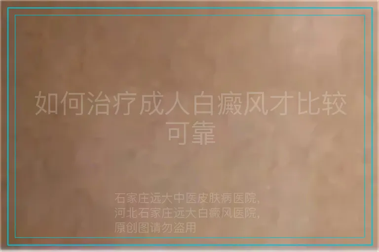 如何治疗成人白癜风才比较可靠