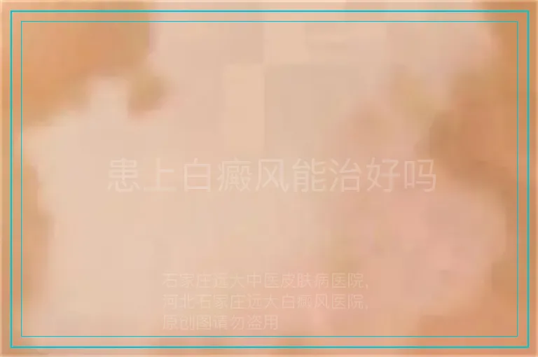 患上白癜风能治好吗