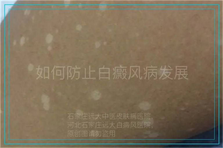 如何防止白癜风病发展