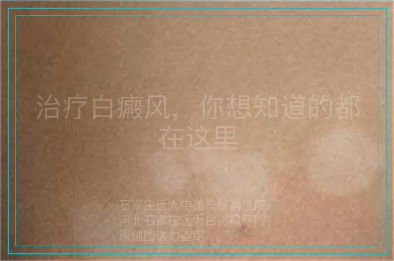 治疗白癜风,你想知道的都在这里