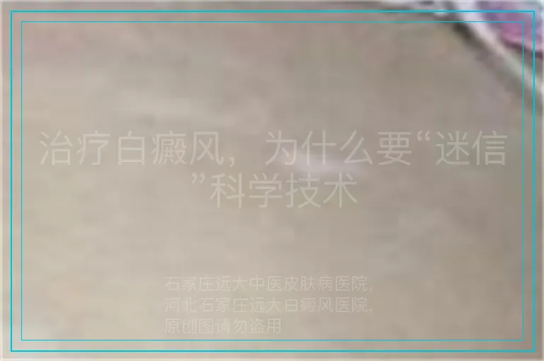 治疗白癜风,为什么要“迷信”科学技术