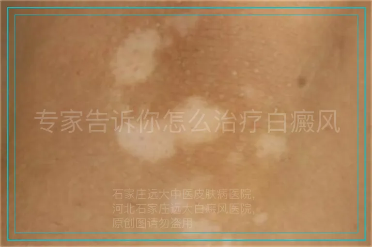 专家告诉你怎么治疗白癜风