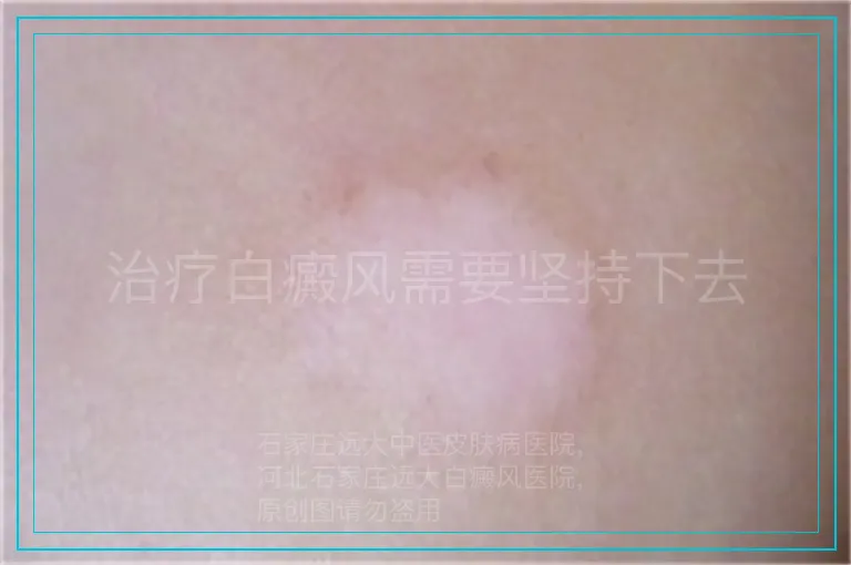 治疗白癜风需要坚持下去