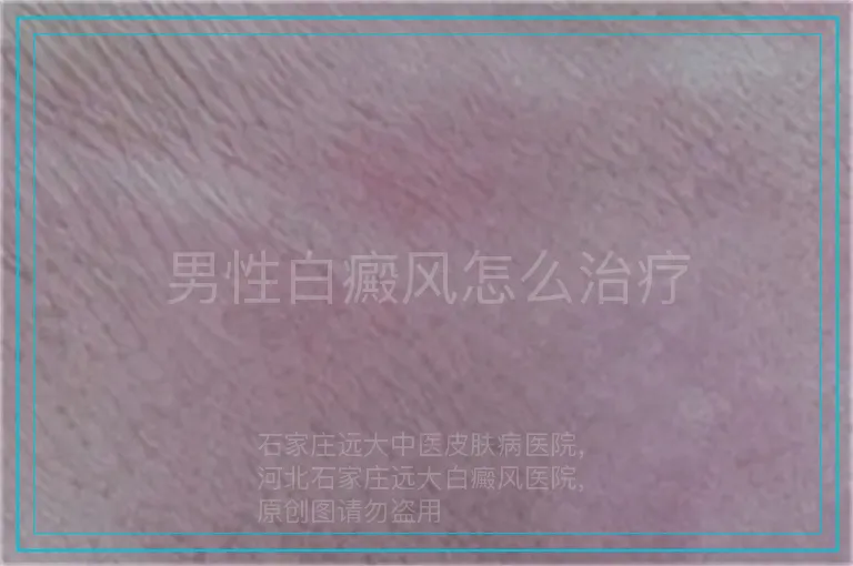 男性白癜风怎么治疗