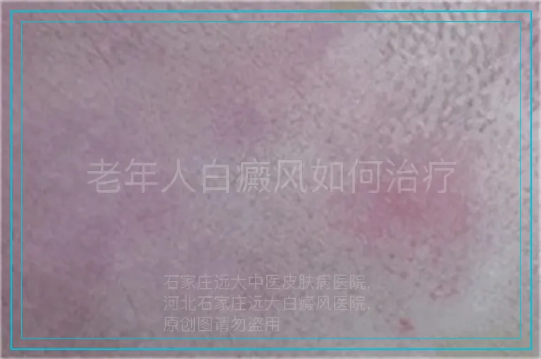 老年人白癜风如何治疗