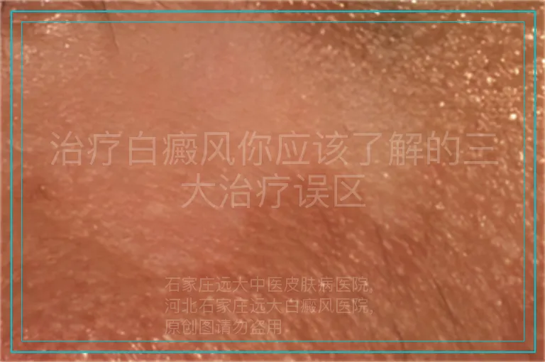 治疗白癜风你应该了解的三大治疗误区