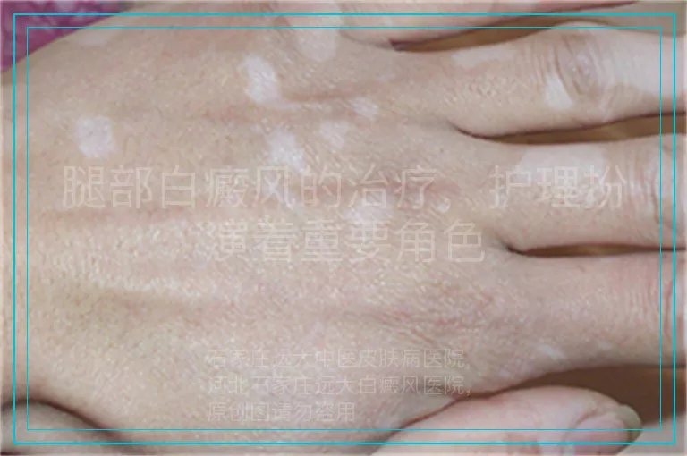 腿部白癜风的治疗,护理扮演着重要角色
