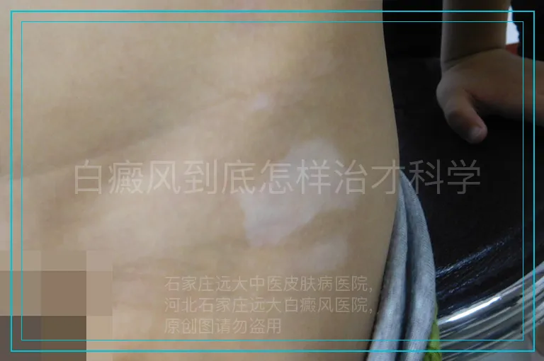 白癜风到底怎样治才科学