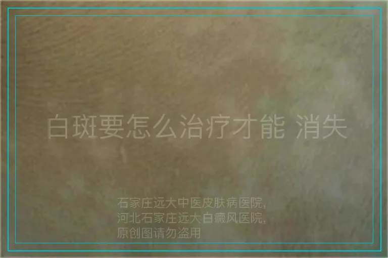 白斑要怎么治疗才能 消失