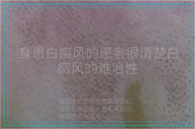 身患白癜风的患者很清楚白癜风的难治性