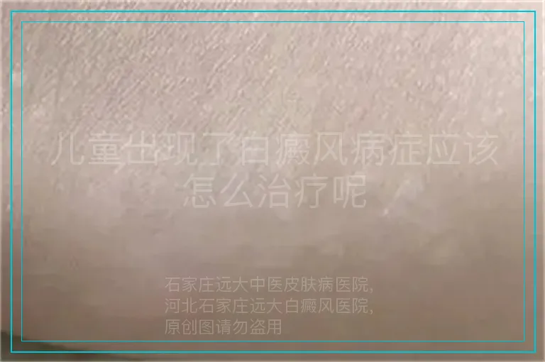 儿童出现了白癜风病症应该怎么治疗呢