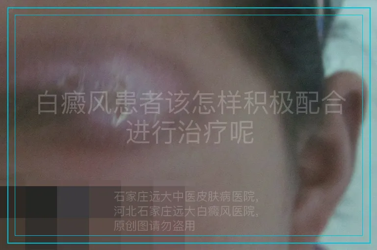 白癜风患者该怎样积极配合进行治疗呢