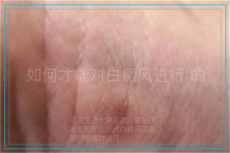 如何才能对白癜风进行 的