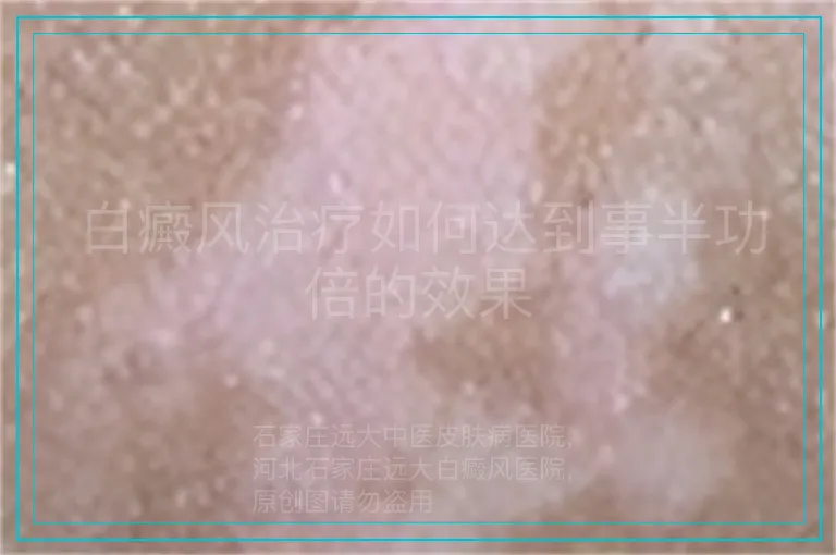 白癜风治疗如何达到事半功倍的效果
