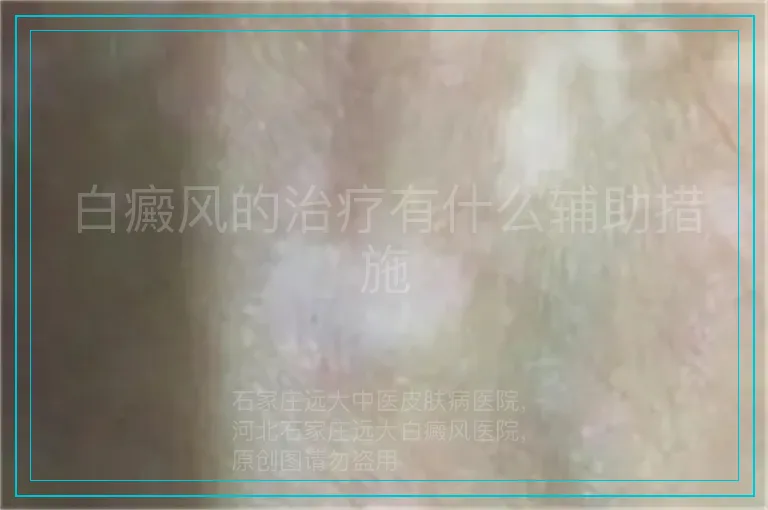 白癜风的治疗有什么辅助措施