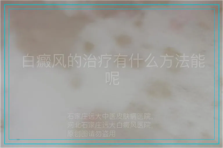 白癜风的治疗有什么方法能呢