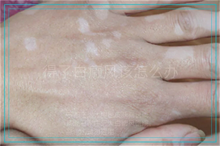 得了白癜风该怎么办