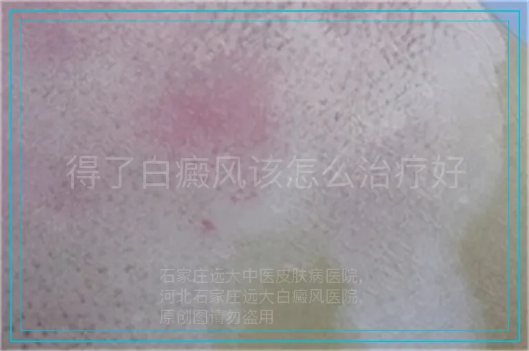 得了白癜风该怎么治疗好