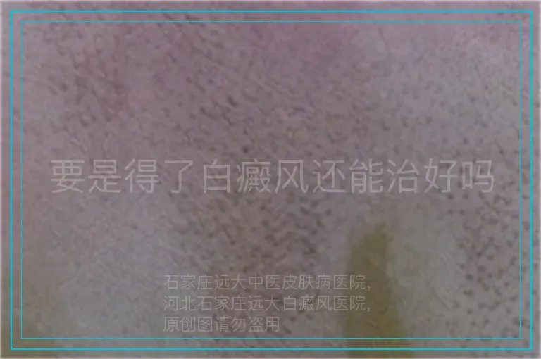 要是得了白癜风还能治好吗