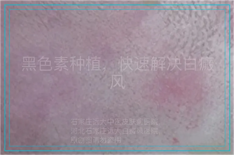黑色素种植，快速解决白癜风