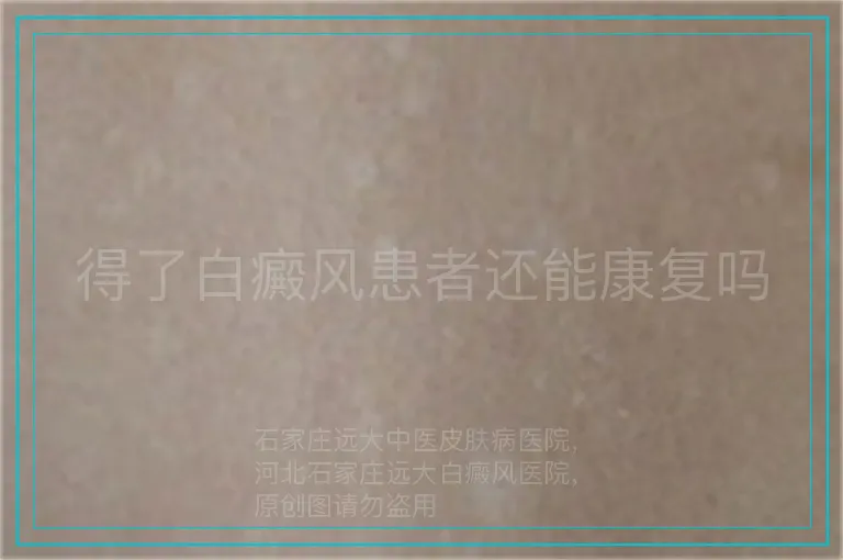 得了白癜风患者还能康复吗