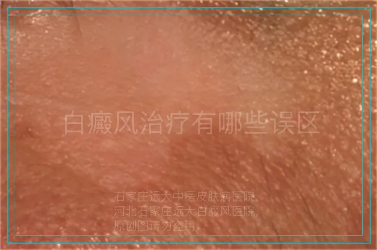 白癜风治疗有哪些误区