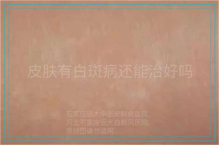 皮肤有白斑病还能治好吗