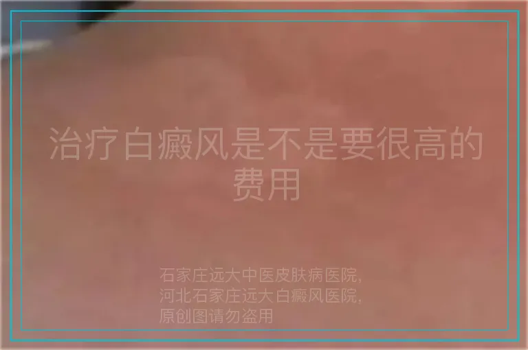 治疗白癜风是不是要很高的费用