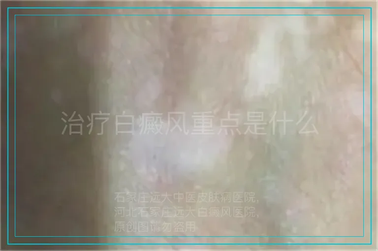 治疗白癜风重点是什么