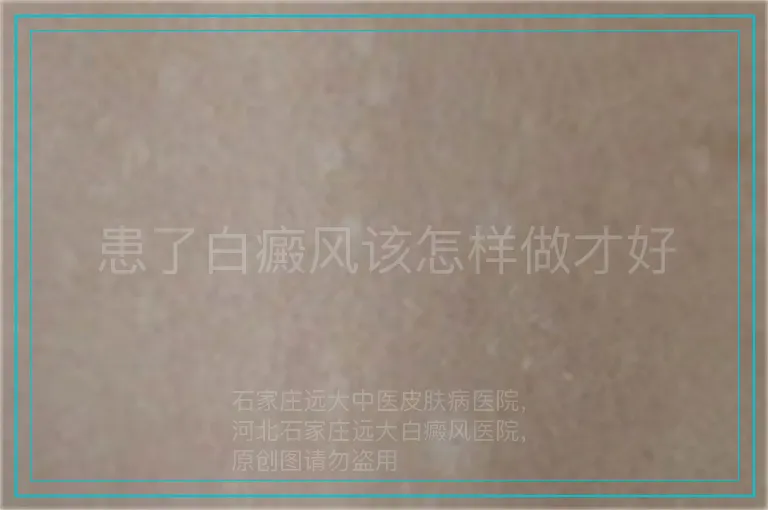 患了白癜风该怎样做才好
