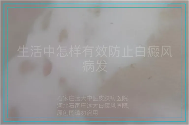 生活中怎样有效防止白癜风病发