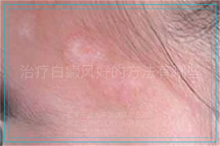 治疗白癜风好的方法有哪些