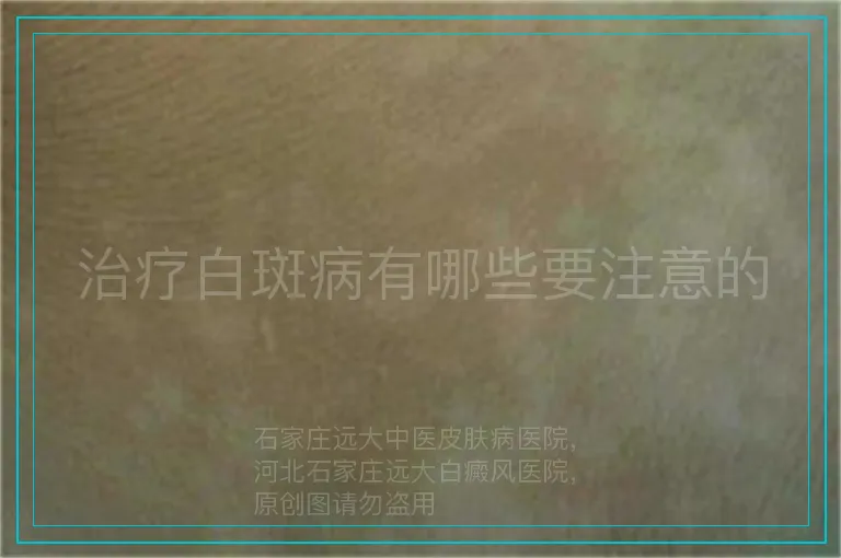 治疗白斑病有哪些要注意的