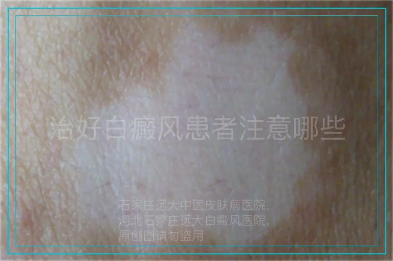 治好白癜风患者注意哪些
