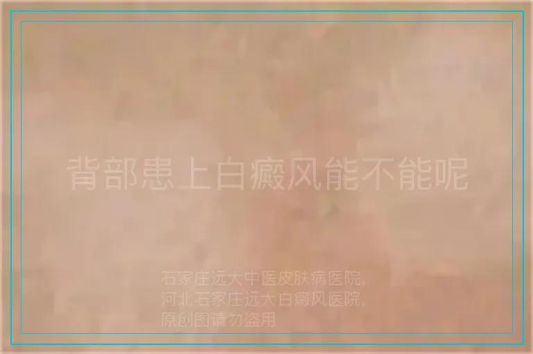 背部患上白癜风能不能呢