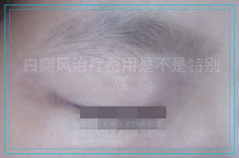 白癜风治疗费用是不是特别高