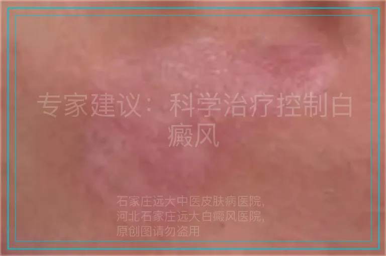 专家建议:科学治疗控制白癜风